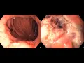 Download Lagu Transoral Outlet Reduction using Overstitch (TORe Procedure)