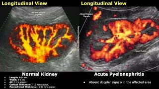 Kidney Ultrasound Normal Vs Pyelonephritis Imaging Findings Acute Chronic Emphysematous Types