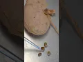Real Kidney Stones