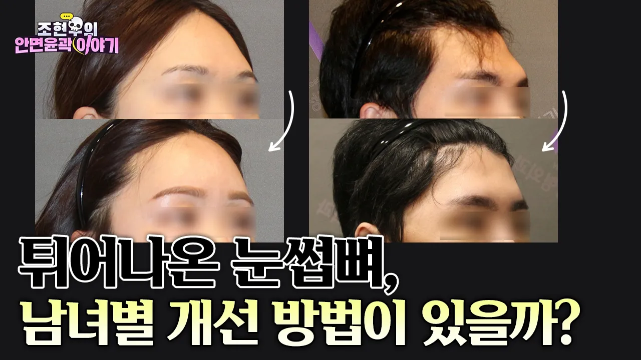툭 튀어나온 눈썹뼈, 어떻게 개선할까? 눈썹뼈축소 전후사진으로 알아보는 수술 방법