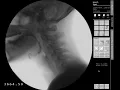 Swallow Study - 13 mm Barium