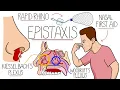 Understanding Epistaxis Nosebleeds Explained