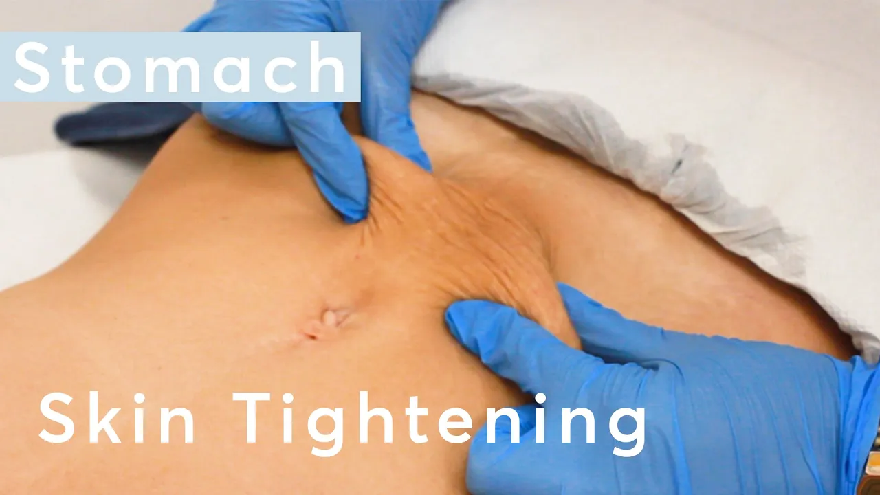 Skin Tightening Stomach - HIFU Ultraformer III Treatment