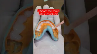 تركيبات مؤق تة بانتظار فينير الاسنان ايماكس وتلبيس الاسنان زيركون 