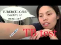 My TB Tuberculosis test experience I was scared