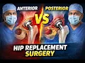Anterior vs Posterior Hip Surgery - What Patients Must Know