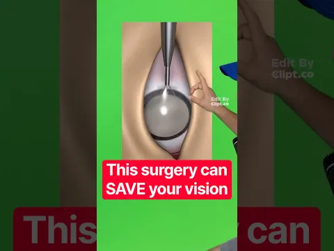 This surgery can SAVE your vision..