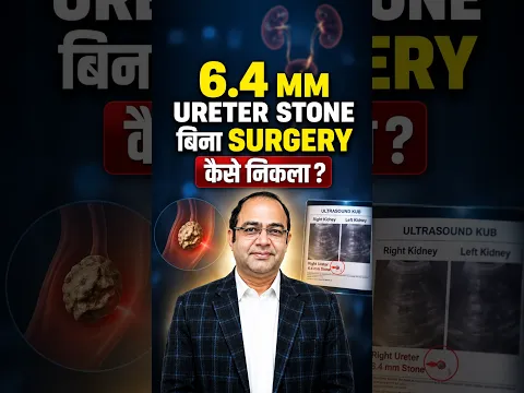 6.4 MM Ureter Stone Surgery कैसे निकली? | Ureter Stone without Surgery Treatment in Hindi