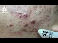Relaxing Acne Treatment Inflamed Acnes