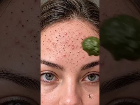 That stubborn blackheads on nose and acne pores Clear smooth skin ✨ #shorts