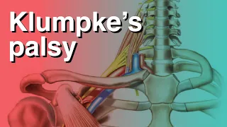 Klumpke s palsy