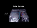 Diagnosing testicular torsion