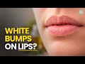 12 Ways To Get Rid Of Fordyce Spots On Lips Healthspectra