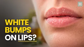 12 Ways To Get Rid Of Fordyce Spots On Lips Healthspectra