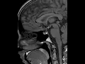 How to read an MRI of the pituitary gland First Look MRI