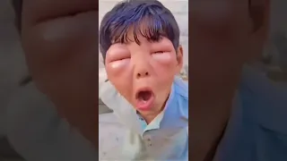 Wasps Sting And Their Sypmtoms Goneviral Waspsting Viral  Wasps Sting And Their Sypmtoms Goneviral Waspsting Viral