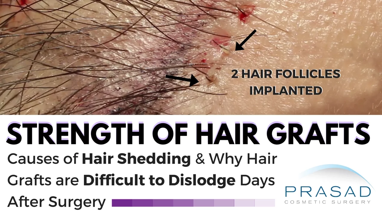 Hair falling out : Shedding after hair transplant- NYC