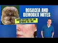 Dermatologist explains Rosacea and the link with Demodex Mites What can be done