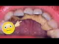 Download Lagu The most satisfying tartar cleaning | Belum Pernah Membersihkan Karang Gigi | Dokter Gigi Tri Putra