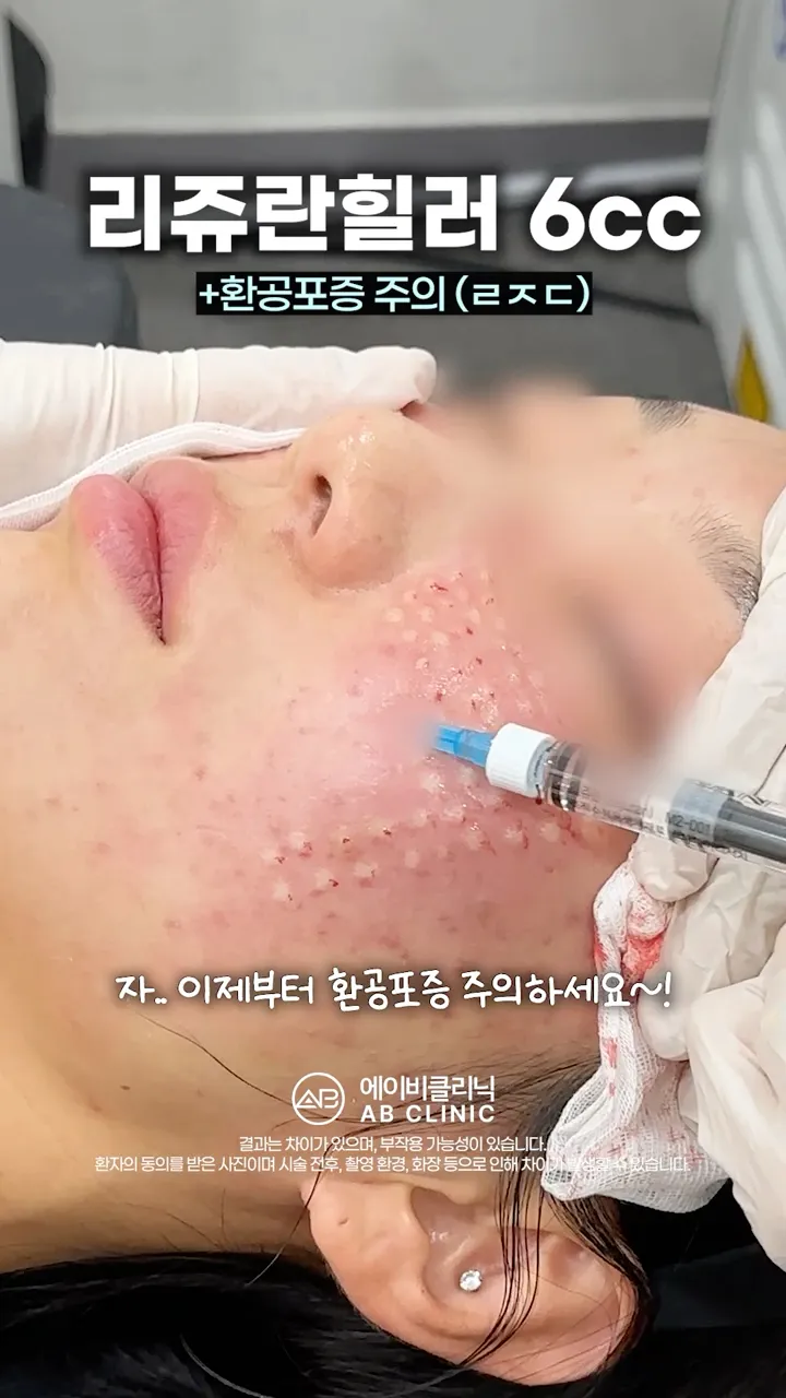 리쥬란 엠보 (환공포증 주의)