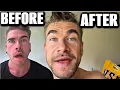 I AM NO LONGER PARALYZED - HOW I CURED RAMSEY HUNT SYNDROME Joel Hansen