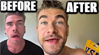 I AM NO LONGER PARALYZED - HOW I CURED RAMSEY HUNT SYNDROME Joel Hansen
