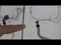 Neurology Patient Story Julia Howell Allen Clinic with Ascension Saint Thomas