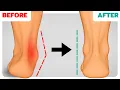 How to Correct Overpronation Fallen Arches