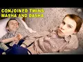 How Conjoined Twins Ended Up Taking Very Different Life Paths
