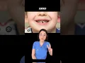 Why treat cavities in BABY teeth