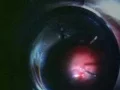 Download Lagu Corp strain intraocular