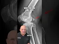 Why Your Knee X-Ray Looks Strange