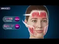 Lagu BTL EMFACE Video Mechanism of Action - Discover Medical Center
