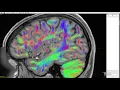 Multi-tissue constrained spherical deconvolution on HCP data