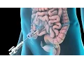 Laparoscopic Lysis of Abdominal Adhesions 2011
