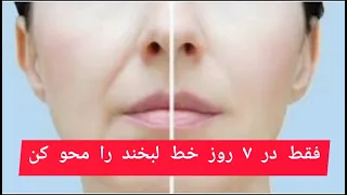 رفع خط خنده در ۷ روز 