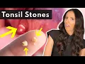 What Are Tonsil Stones How To SAFELY Remove Them