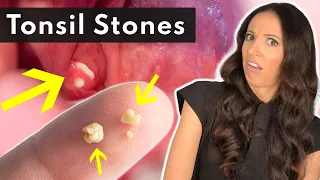 what are tonsil stones u0026 how to safely remove them