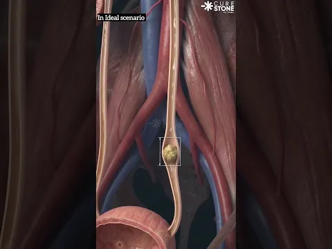 7mm Kidney Stone Treatment #urology