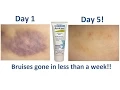 Download Lagu How To Get Rid Of Bruises FAST! | Arnica Gel 📍 How To With Kristin