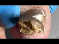 Download Lagu Very Thick Onychomycosis Like A Black Stone, Professional Pedicure【Pedicure Master Lin Jun】