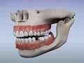 Nesbit Flexible Partial Denture