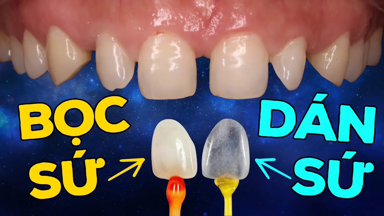 Outline Video Nên Bọc Răng Sứ Hay Dán Sứ Veneer: Bác Sĩ Tư Vấn 6 Tình Trạng Cụ Thể, Xem Ngay Để Không Bị Mài Răng
