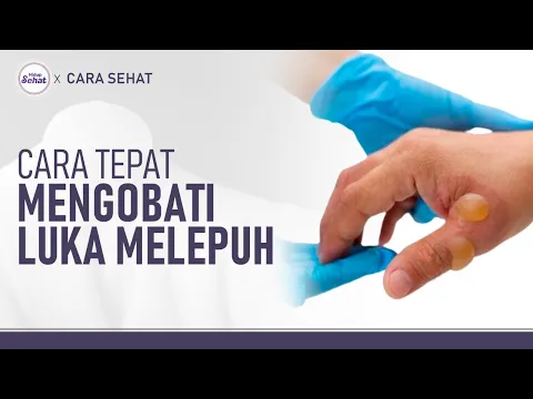 Pertolongan Pertama Luka Bakar Akibat Terkena Minyak atau Air Panas