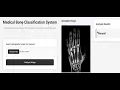 Bone Tumour Detection Using Image Processing and AI Early Diagnosis System