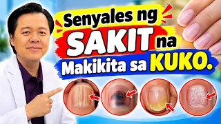 Senyales ng Sakit na Makikita sa Kuko. - By Doc Willie Ong