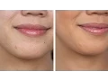 How To Coverup Acne With COVERFX