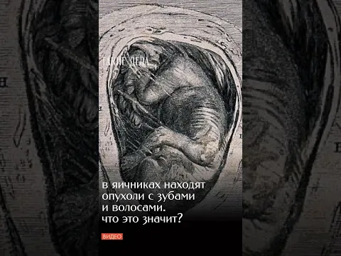 Что такое тератома и как в опухолях начинают расти глаза, волосы и зубы