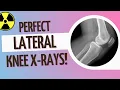 Perfect Lateral Knee X-Ray Positioning Tips Incl Lateral Notch at 4 00