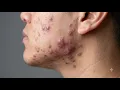 Loan Nguyen Acne Treatment 29zz